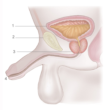 1.Bladder containing urine 2.Pubic bone 3.Enlarged prostate blocking flow of urine through urethra 4.Opening of urethra