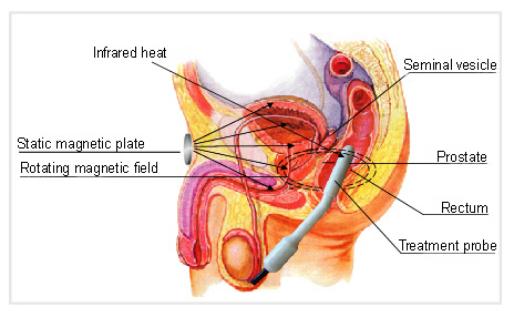 terapia prostata infiammata crampe atunci când urinează la bărbați cum să se trateze